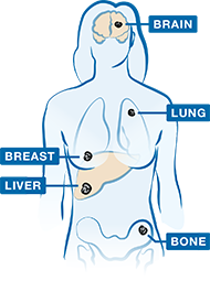 Most common places in the body where MBC may spread.