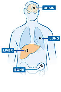 Most common places in the body where advanced NSCLC may spread.