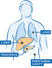 The most common places in the body where advanced pancreatic cancer may spread